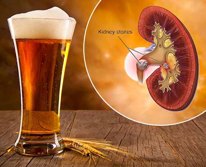 kidney-stone-beer-health-Main